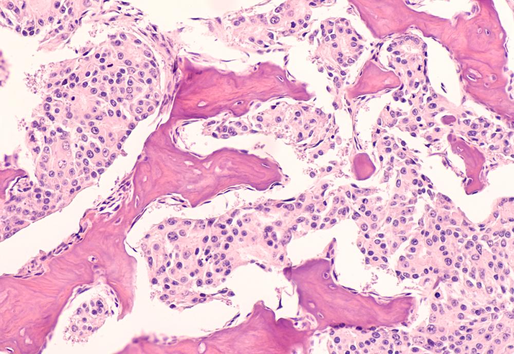 Metastatic prostate cancer: photomicrograph of bone biopsy showing metastasis of prostatic adenocarcinoma within the marrow space.