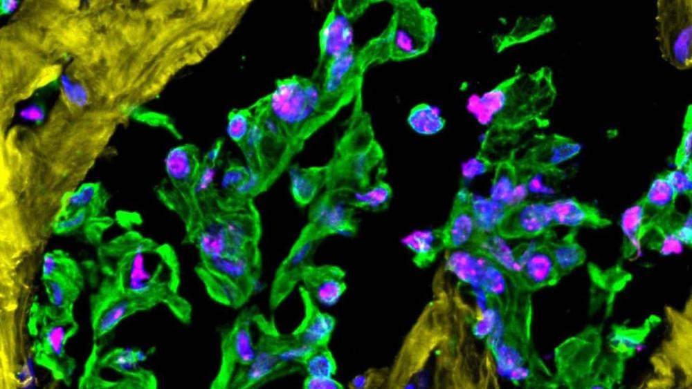 Fibrotic Breast Tumor tissue