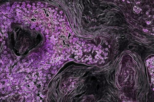 A microscopic image of KRAS-driven lung cancer