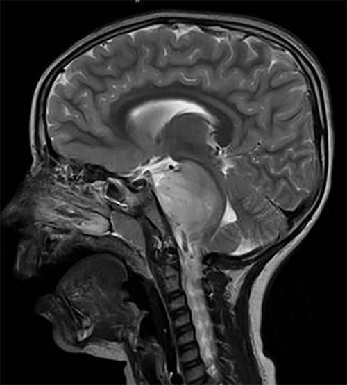 brain scan