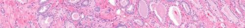 Prostate cancer tissue cells