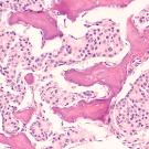 Photomicrograph of bone biopsy showing metastasis of prostatic adenocarcinoma within the marrow space.