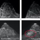 Changes in ipsilateral breast MRI features, Fig. 5, DOI:10.1038/s41523-024-00677-9