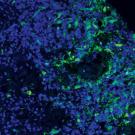 Microscopy of glioblastoma cells invading a brain organoid, with glioblastoma cells in green and brain organoid cells in blue