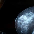 Breast Cancer mammography