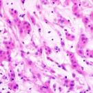 A microscopic image of chordoid glioma. A microscopic image of chordoid glioma.