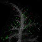 Microscopic image showing metastatic pancreatic cancer cells in a lung.