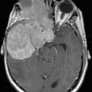 Meningioma scan Credit Raleigh lab / UCSF Brain Tumors Scan