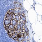 micropapillary bladder cancer