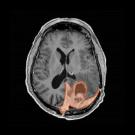 Brain scan showing a meningioma highlighted in orange. Photo by UCSF Brain Tumor Center