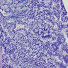 prostate cancer cells