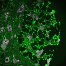A microscopic image of breast tissue showing molecular tunnels briding tumor cells with nearby fat cells.
